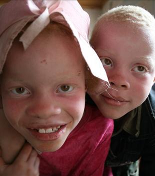 La caza de albinos en África (2011)